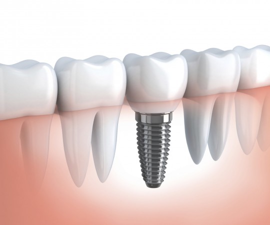 Implante Dentário